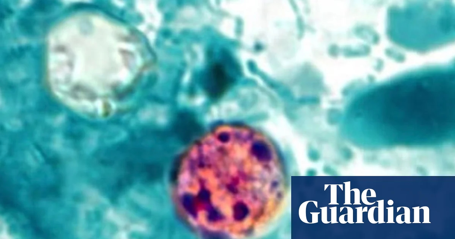 Global Health and Education Watch: Cyclospora outbreaks causing diarrhea in US expected to continue