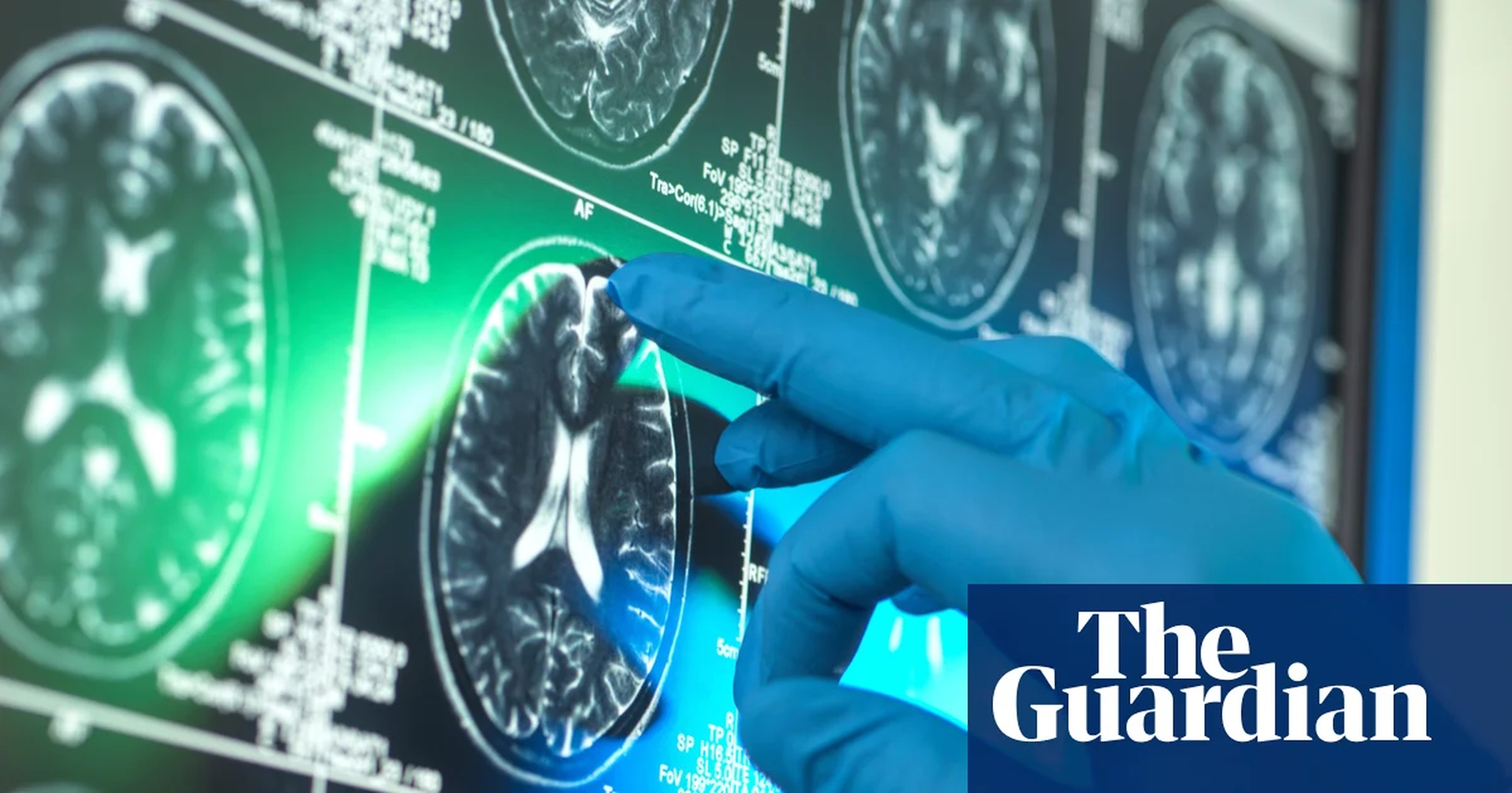 Global Health and Education Watch: Alzheimer’s research is latest casualty in Trump administration war