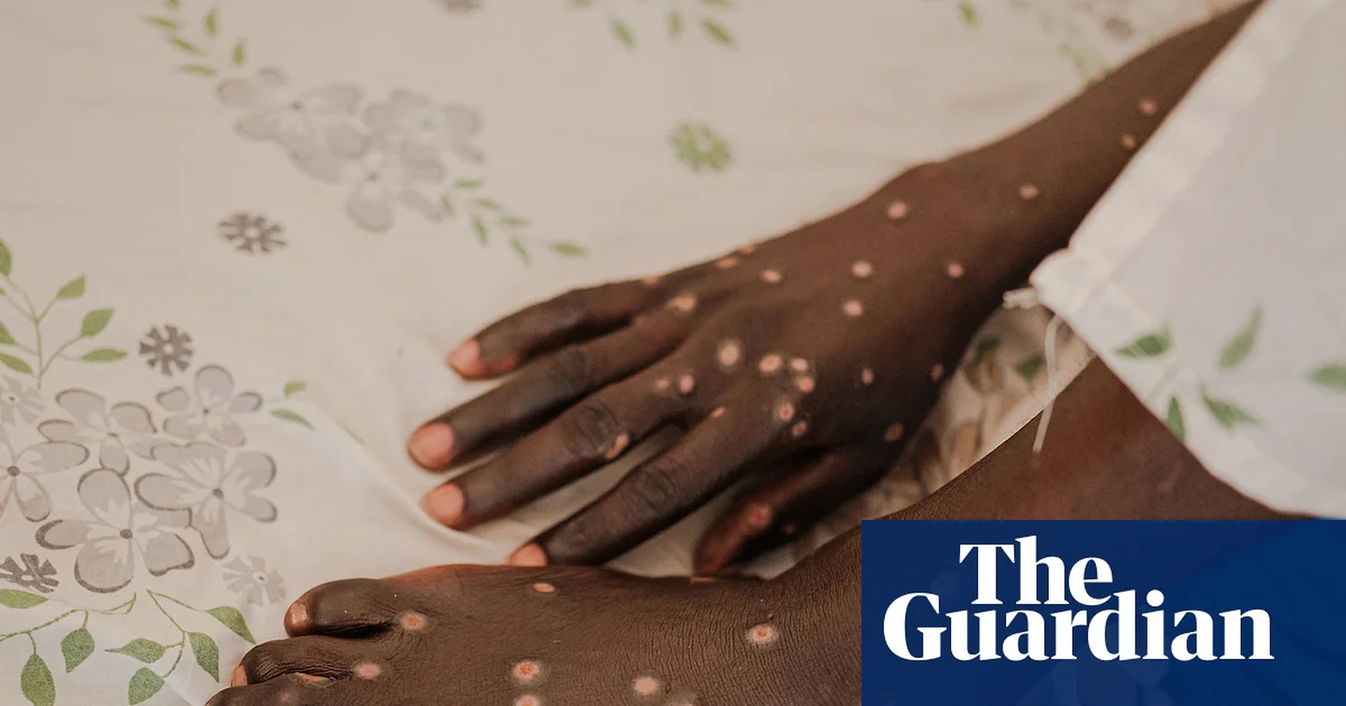 Global Health and Education Watch: Mpox is back – and in new countries. How